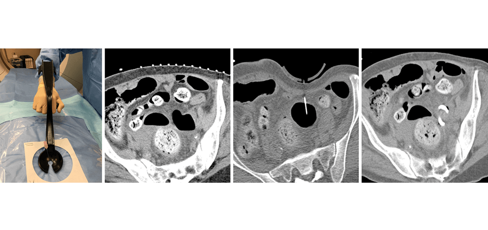 use-3d-printed-abdominal-compression-device-facilitate-ct-fluoroscopy-guided-percutaneous-interventions-3 use-3d-printed-abdominal-compression-device-facilitate-ct-fluoroscopy-guided-percutaneous-interventions-3